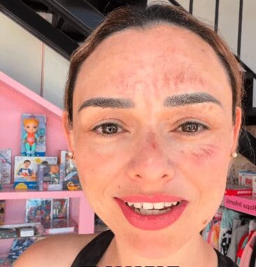 Influencer chihuahuense sufre quemaduras al recrear un trend viral en su cumpleaños