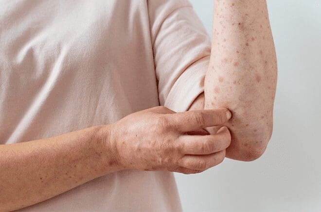 La OPS emitió una alerta por el brote de sarampión en América, con México como el país con más casos confirmados.