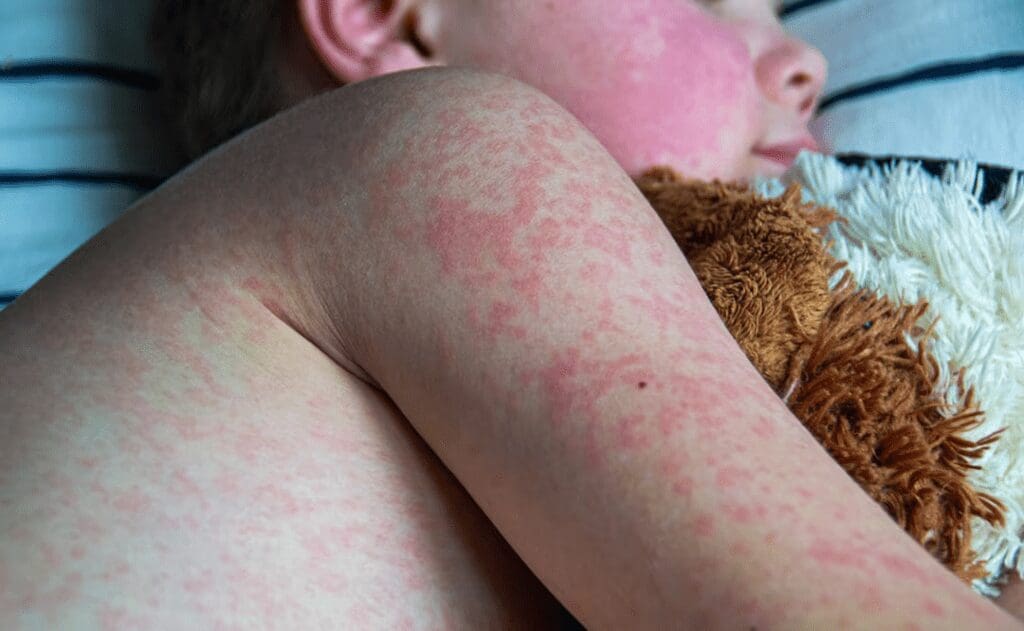 El sarampión registra un repunte en México y representa un nuevo reto sanitario.