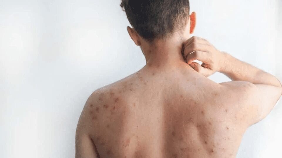 Confirman primera muerte por sarampión en CDMX mientras aumentan los contagios en México.