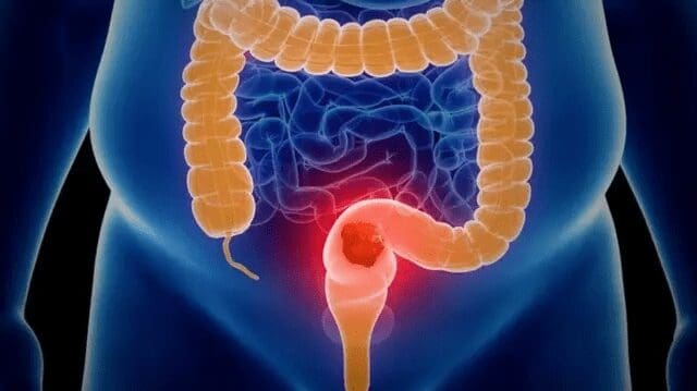 Cómo reconocer a tiempo los síntomas del cáncer de colon