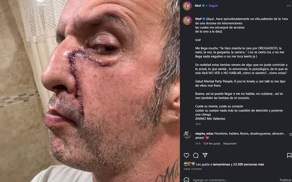 Tito Fuentes de Molotov es hospitalizado por cirugía reconstructiva tras problemas de adicciones.
