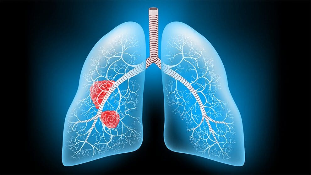 Secretaría de Salud de Chihuahua alerta sobre cáncer de pulmón y llama a la prevención.