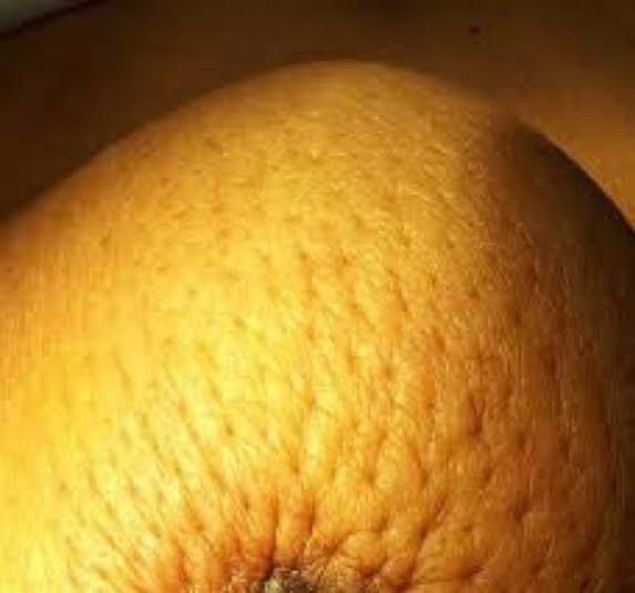 Piel de naranja en el seno podría tratarse de un cáncer de mama poco común