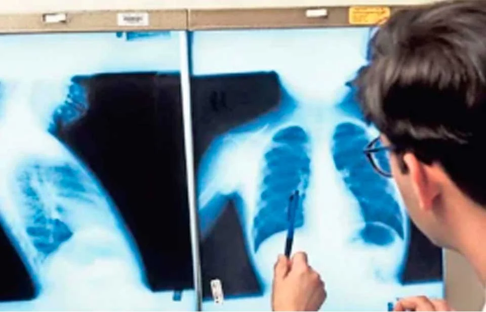 Confirma Secretaría de Salud 87 defunciones por tuberculosis en la entidad